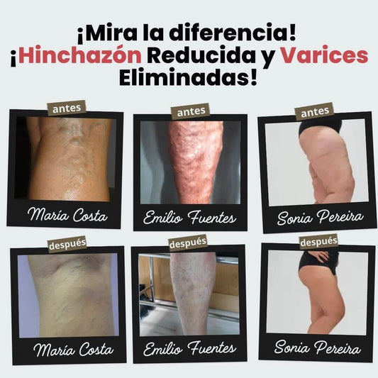 Calcetines de acupresión Anti-Varices